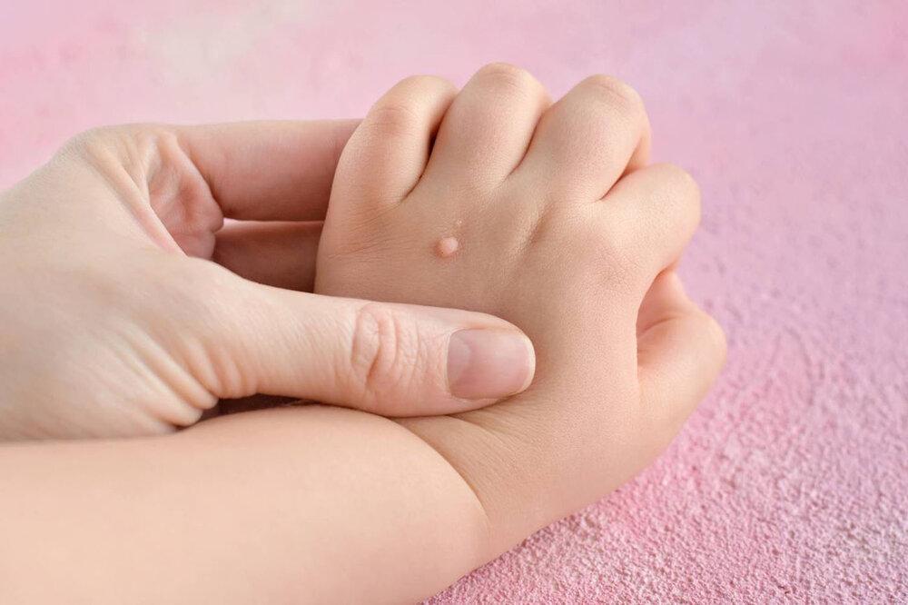 تفاوت خال گوشتی و زگیل چیست؟/ آیا کندن  زگیل با ناخنگیر یا بستن نخ خطرناک است؟